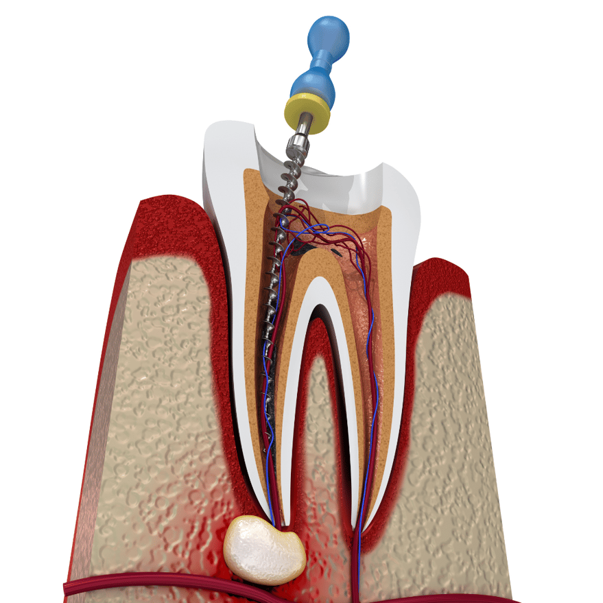 A stepbystep guide to the endodontic workflow