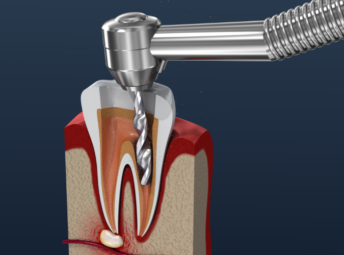 endodontics, endodontic workflow, dentistry, endodontic treatment